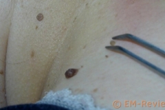 EM-Reviews_Tatuajes_Verrugas_Eliminar_con_Kayboo6525