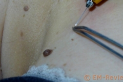 EM-Reviews_Tatuajes_Verrugas_Eliminar_con_Kayboo6526