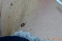 EM-Reviews_Tatuajes_Verrugas_Eliminar_con_Kayboo6527